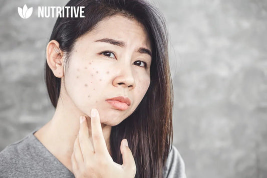 Чорні точки - як запобігти та як боротися? ТОП дієвих порад - Nutritive Cosmetics