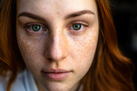 Пігментація шкіри: причини, типи та ефективні методи лікування - Nutritive Cosmetics